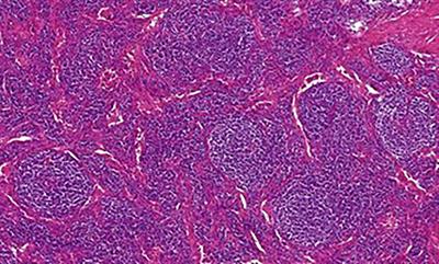 Unicentric form of Castleman´s disease, pitfalls of diagnosis and surgical treatment